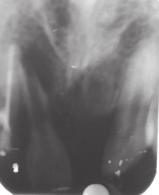 4 Case Reports in Dentistry (a) (b) (c) (d) (e) (f) Figure 3: (a) Preoperative IOPA, (b) unintentional extrusion of MTA from apical foramen, (c) 1-month follow-up, (d) 2-month follow-up, (e) 3-month
