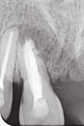 (Figure 3(b)). A moistened cotton pellet was placed in the root canal and the patient was kept under observation for 15 days.