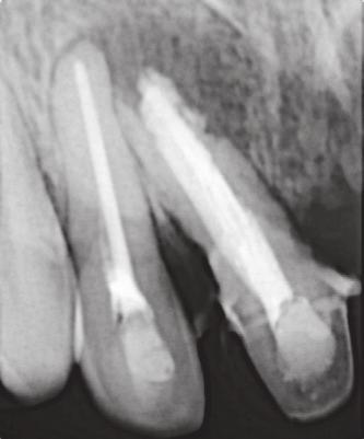 At the one-month follow-up appointment (Figure 3(c)), the tooth was asymptomatic.