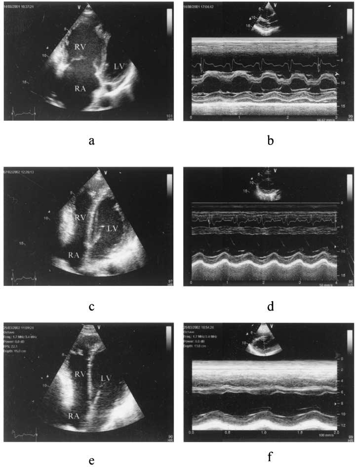 Volume 16 Number 5 Dambrauskaite et al 433 Figure 1 Two-dimensional apical 4-chamber view recorded: (A) before lung transplantation (LT) (right ventricular [RV] longitudinal dimension [ld] 7.