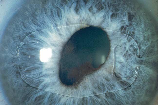 Ophthalmology Volume 110, Number 7, July 2003 Discussion Figure 4.