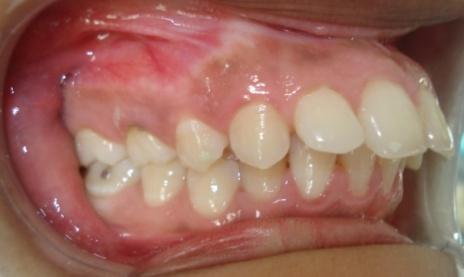 anterior teeth proclination along with gummy smile.