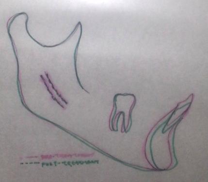 The overjet and overbite was also tried to be normalized to 2mm and 1mm respectively (Fig 5a-i). The maxillary first molars were distalized 3.