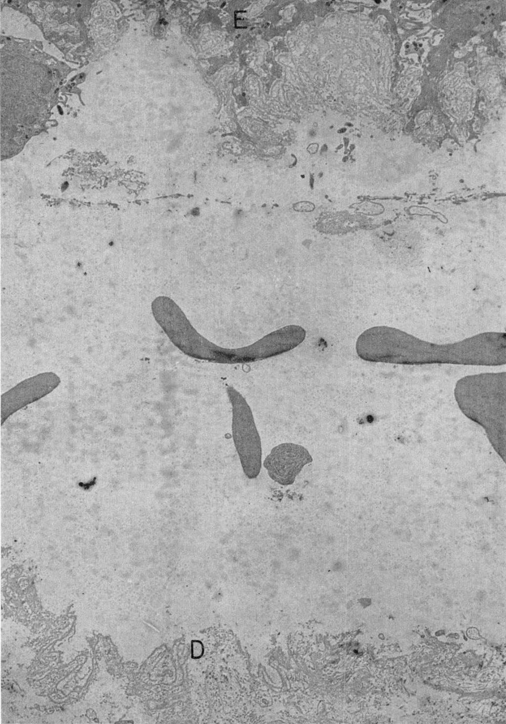 STUDIES ON THE PATHOGENESIS OF EPIDERMOLYSIS BULLOSA 571 ''s -- r.t:: r% -- t:-'- - - n 'S - - a r 4 A- we I 1: t.' S FIG. 22. Porphyria cutanea tarda. Low magnification electron micrograph.