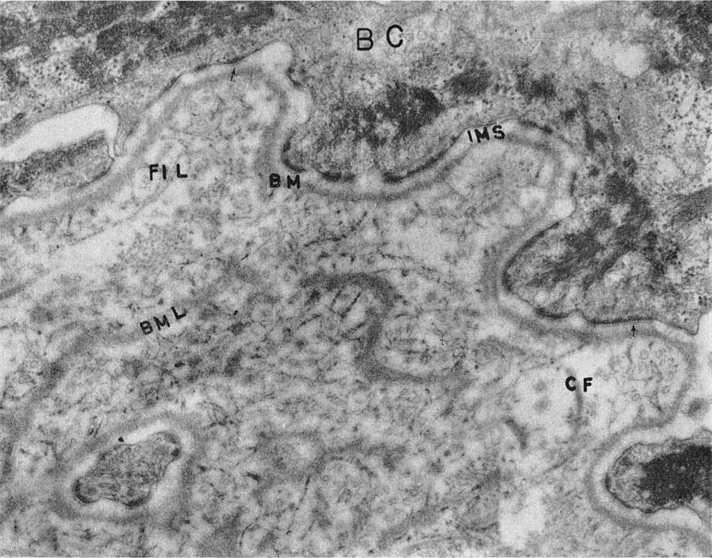 Light microscope examination showed a nearly complete dermal-epidermal separation. The dermal side was lined by a PAS positive basement membrane. (Fig. 3).