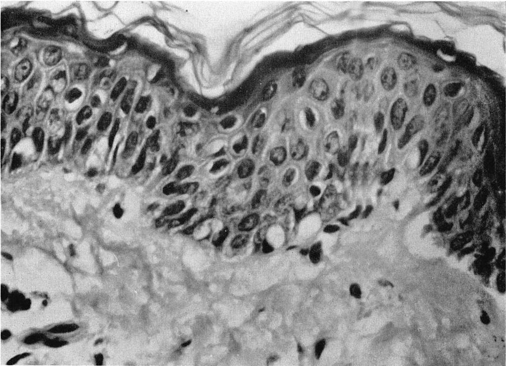 staining of the papillary dermis. In blisters, fragmentation of the papillary dermis was often apparent and debris collected within the separation (Fig. 10).