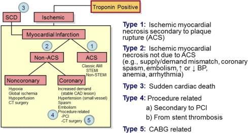 Analytical Issues What is a Temporal Rise and/or Fall in Troponin?