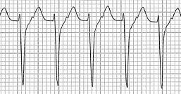 Short R-P Tachycardia REGULAR with 1:1 P/R relationship RP<PR RP>70 AVRT AVNRT AT RP<70 AVNRT RP>PR AT Atypical AVNRT