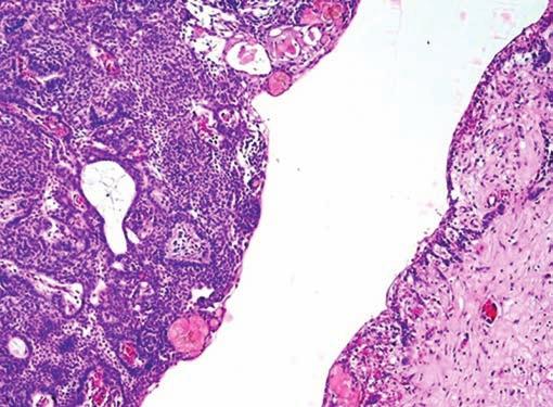 However, several clusters of ghost cells surrounded by foreign body-type giant cell along with calcified materials and dentinoid formation could be seen in the fibrous connective tissue.