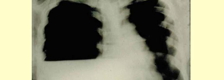 Chest Radiograph Pearls Hilar nodes, pleural disease extrapulmonary, few