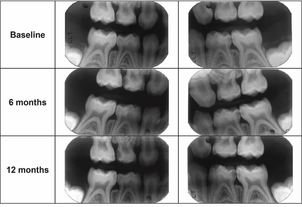 Silver nitrate doesn t stop all caries progression Decay can continue to progress following silver nitrate application Food impaction