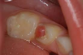 polyp, which may become epithelialized by oral epithelial cells present in saliva.