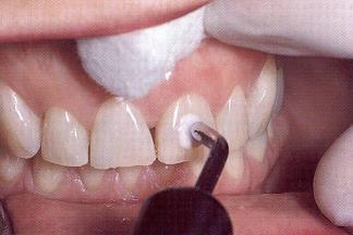 ELECTRIC PULP TEST False positive reading: Electrode contact with metal restoration or gingiva