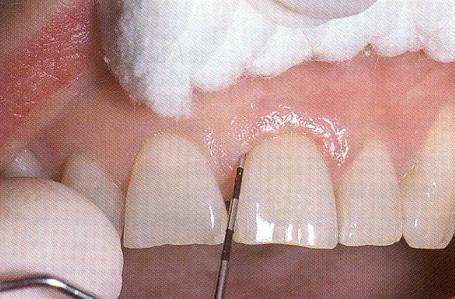 PERIODONTAL EXAMINATION Periodontal probing pocket depths must be measured and recorded A significant pocket, in the absence of