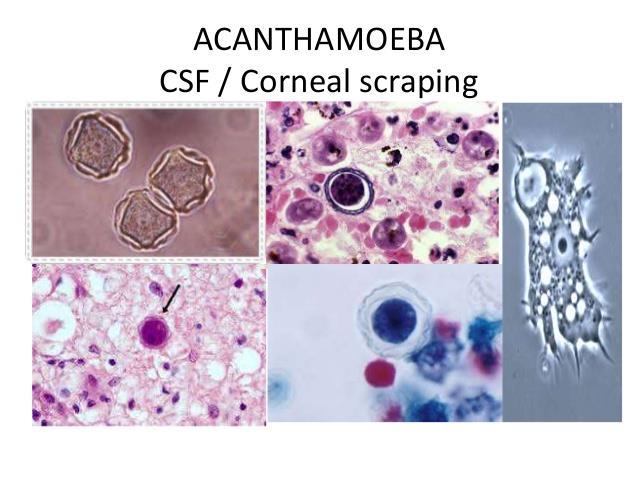 Acanthamoeba Primary amebic meningoencephalitis, Brain, spinal cord, eye infections in Swimming ponds and rivers, and lenses contaminant.