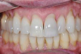 Class Four Fractures Increase Reduction as you roll over incisal Repair with opaque Composite Restore with Hand