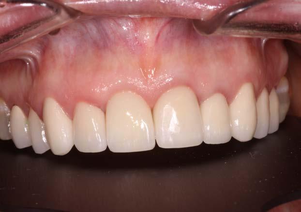 Have adequate reduction on crown preps for core, dentin layer and equal thickness of