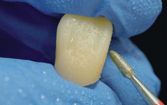 6 FINISHING Finish the prosthesis by: refining the surface texture, polishing areas in contact with the opposing tooth,