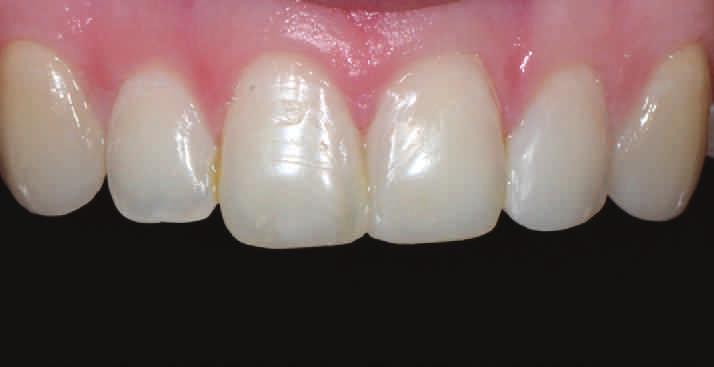 4 translucencies to beautifully match all your indications Veneers