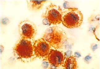 Myeloma Cells CD-38