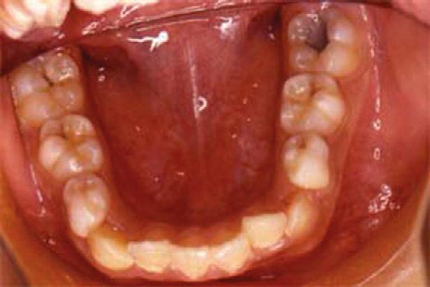 It is always a great concern for parents to discover unpleasant anterior dentition when unerupted maxillary permanent incisors occur because of obstruction of the supernumerary teeth during a child s