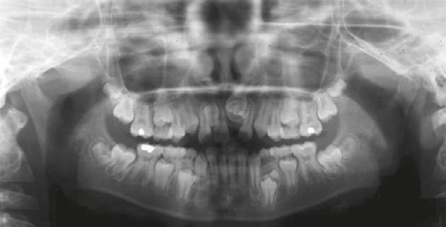 Multiple supernumerary teeth 161 Fig.