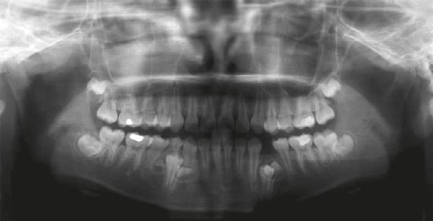 162 Y.T. Lin et al A B Fig. 5 Two supernumerary premolars found in the right mandibular premolar region 3 months later. Fig. 6 A lingual button bonded onto the impacted left mandibular first premolar for orthodontic traction.