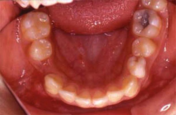 10,11 Yusof 12 reviewed most of the literature and found that a predominance of non-syndrome multiple supernumerary teeth occurred in the mandibular premolar area.