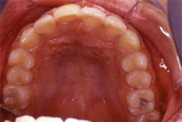 4 years, and an extremely high occurrence rate of 74% for mandibular premolars.