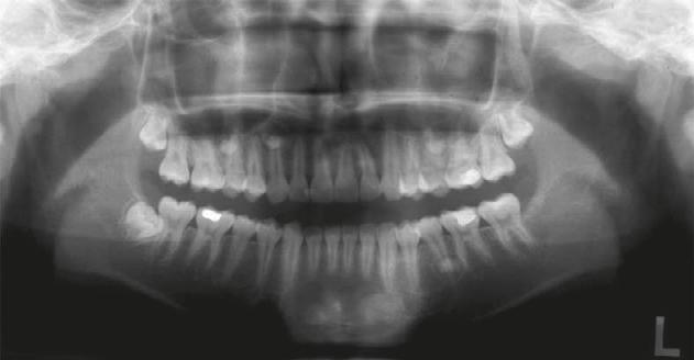 Multiple supernumerary teeth 163 A Fig. 8 An additional four supernumerary premolars found in a follow-up panoramic radiograph. B C Fig.