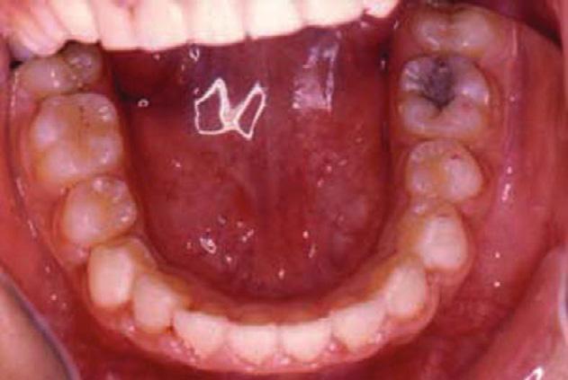 Hanratty 21 suggested removal of more developed supernumerary premolars be accomplished soon after diagnosis, but less developed premolars be left in situ and removed later in order to avoid damage