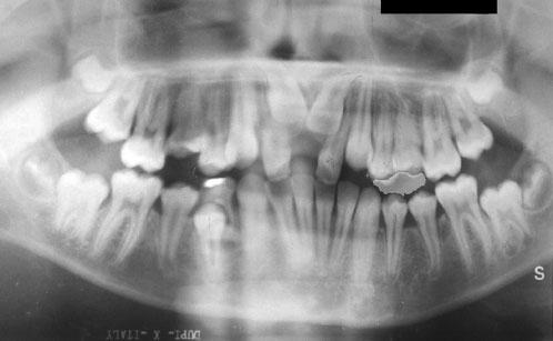 Intra-oral radiographs supplied (Figure 1) revealed the presence of two anterior maxillary supernumeraries preventing the eruption of both maxillary central incisors.