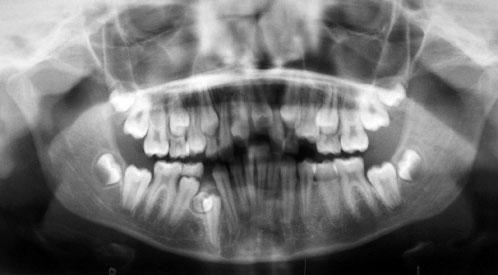 This showed eruptive progress of the maxillary central incisors, but there was mucosal impedance of the upper left incisor and the (then) more developed supernumerary premolar was inhibiting eruption