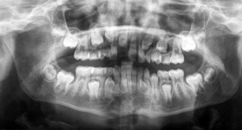 Case report 3 LW panoramic radiograph A consultant in Paediatric Dentistry referred LC, a girl aged 9 years 4 months, to the Orthodontic Department in November 2004.
