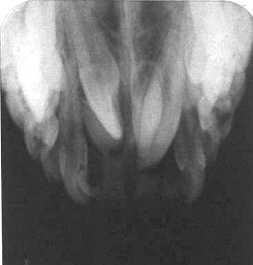 JO December 2006 Clinical Section Supernumerary teeth in the pre-maxillary region 253 Figure 9 WR panoramic radiograph 5th April 2005.