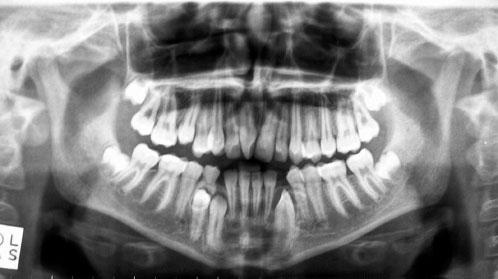 incisors. An orthopantomograph taken showed two supernumeraries occlusal to the maxillary central incisors and these were lying superiorly compared with the maxillary lateral incisors (Figure 10).