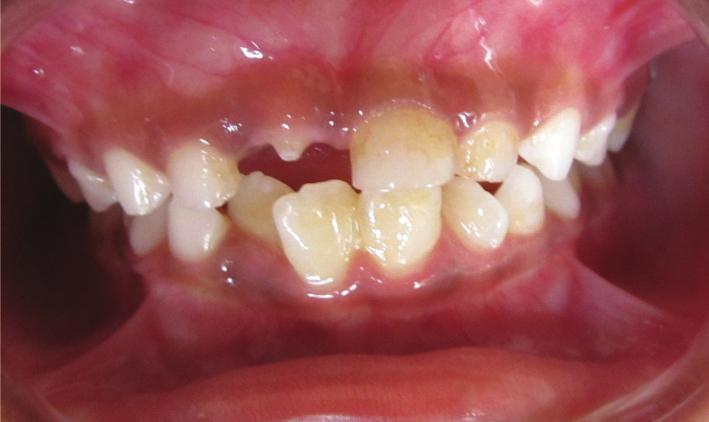 2 Case Reports in Dentistry (c) Figure 1: Showing erupting mesiodens in place of central incisor, showing occlusal view of mesiodens, and