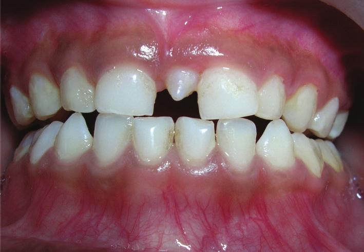 3. Case 3. A 5-year-old male patient was reported for the dental checkup. On examination mesiodens was seen in upper arch (Figure 3).