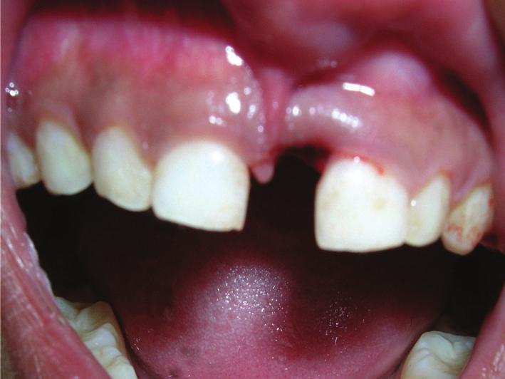 Considering that the presence of mesiodens may be responsible for noneruption of permanent central incisors, thus, as a precautionary