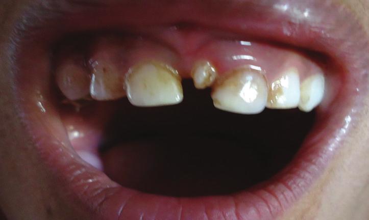 Case Reports in Dentistry 3 Figure 3: Showing mesiodens in upper arch. Radiograph showing rotated mesiodens and permanent incisor.