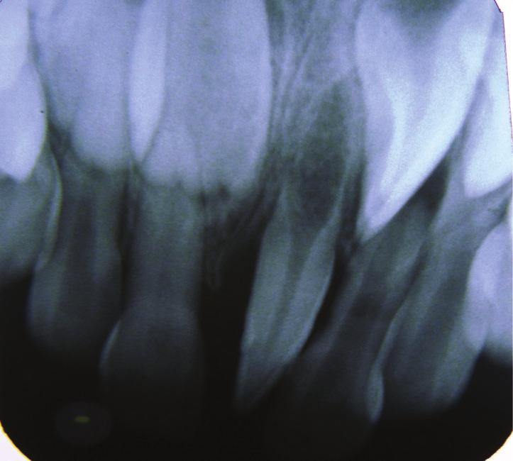 Anterior occlusal radiograph showed missing permanent mandibular tooth buds of 31, 32, 33, 41, 42, and 43 in lower anterior region with an embedded and obliquely placed supernumerary tooth which was