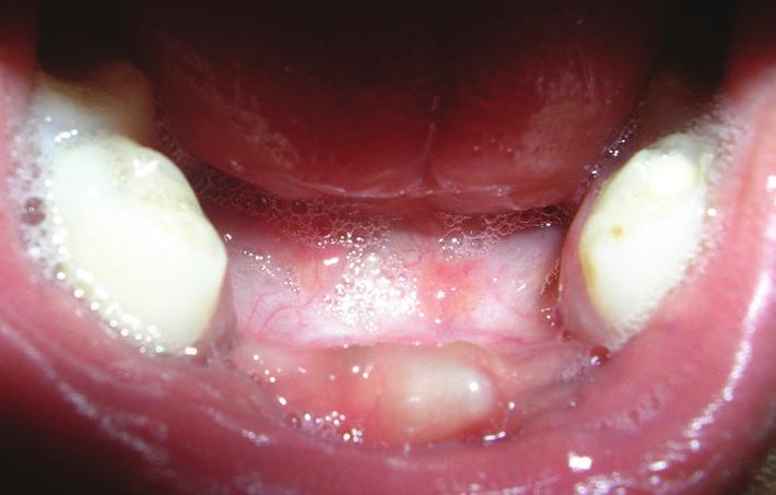 The treatment was aimed at addressing the patient s need for improved speech and aesthetics. So the embedded supernumerary tooth was extracted. 3.