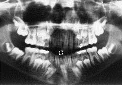 1c Case 2 An 11-year-old male presented with a chief complaint of an extra front tooth. Medical and family histories were unremarkable.