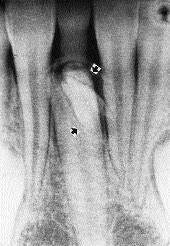 2b). Treatment involved extraction of the most distal upper right lateral incisor, the most distal and displaced upper central incisor, and placement of upper and lower bands on first molars and