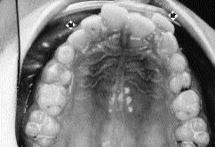 2a 2b 3a 3b 4a Fig. 2. Case 2. a (top left), Intra-oral view of the maxillary arch.