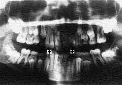 Note supernumerary teeth erupting buccal to upper right and left second permanent
