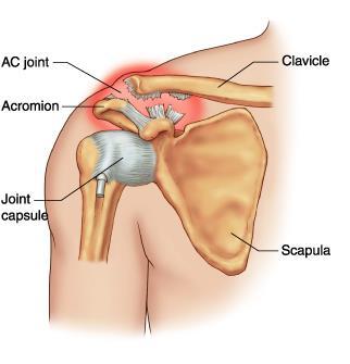 The joint s stability relies mainly on two ligaments (the coracoclavicular ligaments) that connect the collar bone with the front part of the shoulder blade (coracoid process).