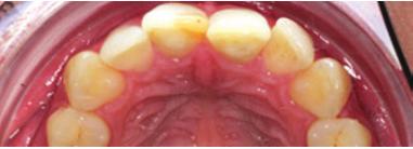 It was planned to create direct composite restorations on the central incisors: A class IV restoration on tooth 11 and an extension of the incisal edge of tooth 21, mainly in order to optically
