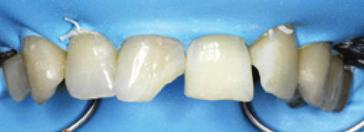 3 In the first step, the palatal area of the central incisors was built up (Fig. 7).