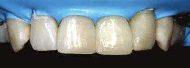 At this stage, it is already decisive to take into account the space required for the labial enamel layer which is also responsible for a natural incisal translucency.